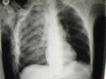 Pulmonary_contusion